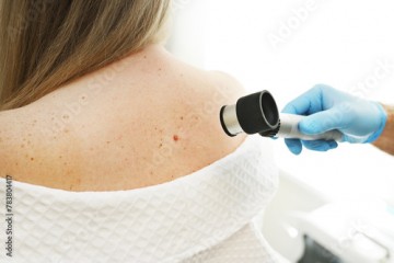 a dermatologist examines moles and skin growths on the patient's body using a special device - a dermatoscope. Diagnosis and prevention of melanoma.
