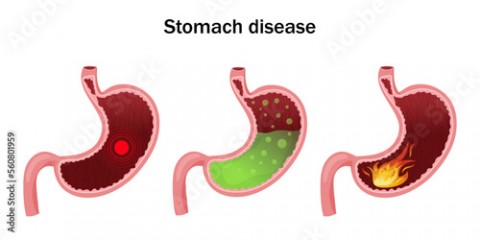 Stomach disease. Pain, increased acidity and burning in stomach. Vector illustration, cartoon style